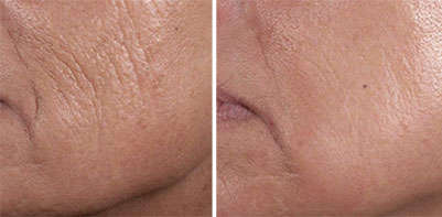 Results of injectable anti-wrinkle treatment