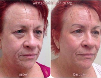  Cheekbone enhancement before and after