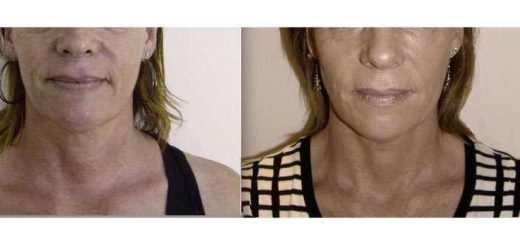 Facial rejuvenation treatments “With” and “Without” surgery