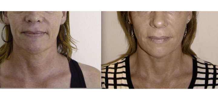 Facial rejuvenation treatments “With” and “Without” surgery