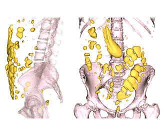  Flatulence and intestinal gases