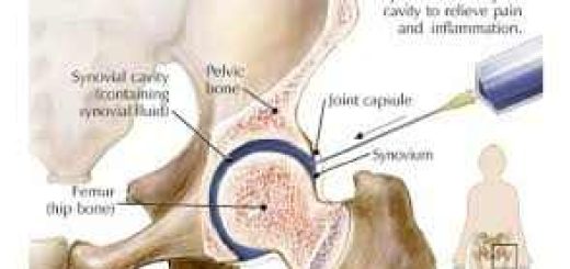 Hyaluronic Acid in the Knee as a Treatment for Osteoarthritis