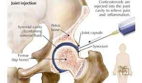 Hyaluronic Acid in the Knee as a Treatment for Osteoarthritis