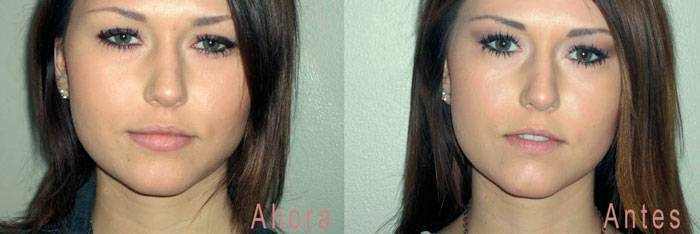 Hyaluronic acid in lips before and after