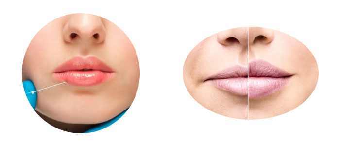 Price of hyaluronic acid for lips (enhancement and injection)