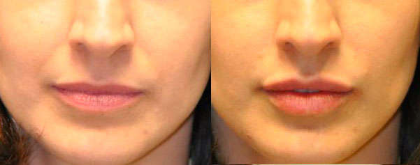 Results of hyaluronic acid on lips