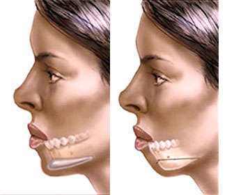 Intraoral mentoplasty