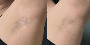 Advantages of Laser Hair Removal