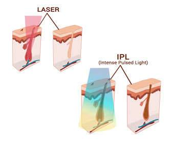 Photoepilation vs Laser