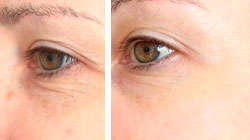 Results of removing wrinkles around the eyes with hyaluronic acid