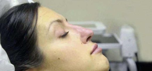 Rhinomodeling, non-surgical rhinoplasty