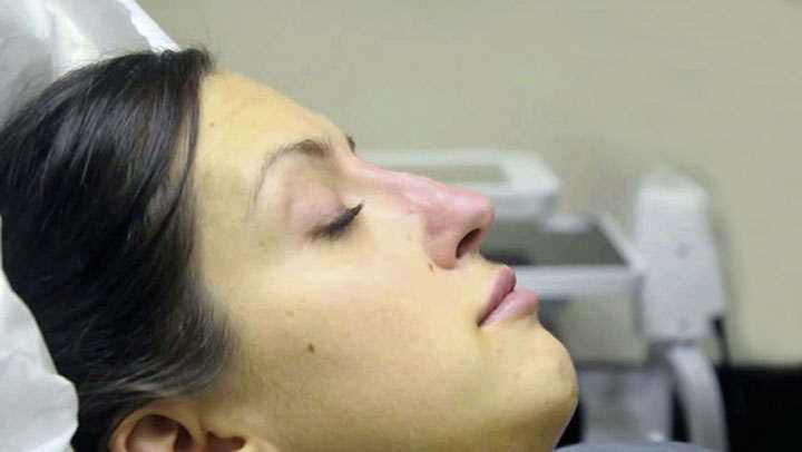 Rhinomodeling, non-surgical rhinoplasty