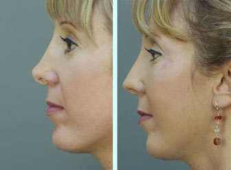 Rhinoplasty before after