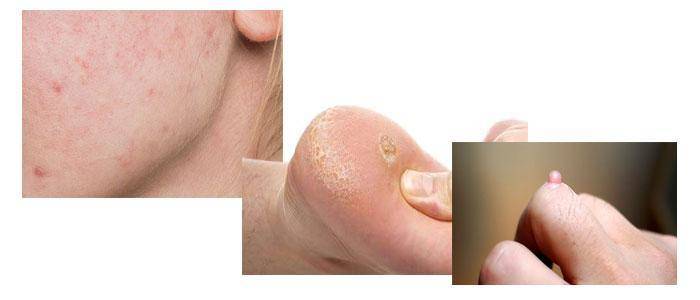 Uses of Salicylic Acid for Acne, Warts, and Calluses