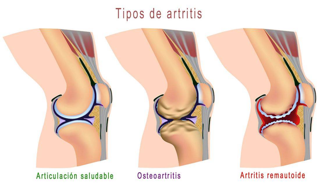 Knee Arthritis Treatment with Hyaluronic Acid