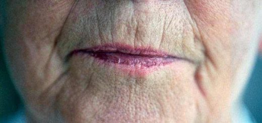 Upper lip and around the mouth wrinkle