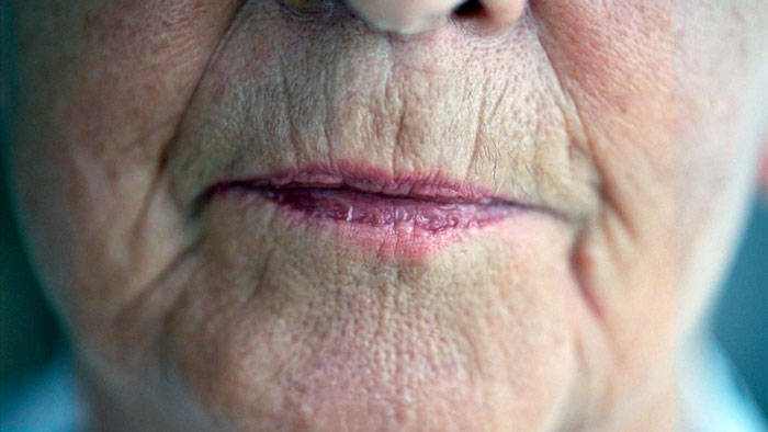 Upper lip and around the mouth wrinkle