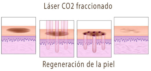 laser CO2 fraccionado para cicatrices