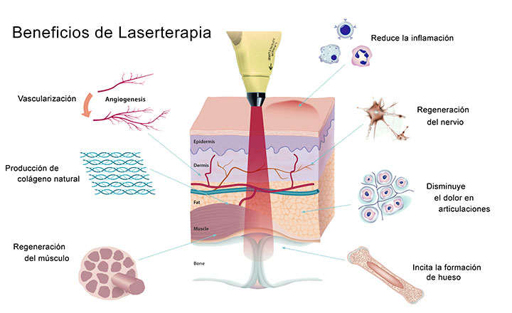 Usos y beneficios de laserterapia