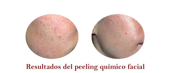 Resultados del peeling químico facial o exfoliación química