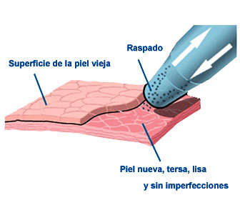 tratamiento con microdermoabrasion